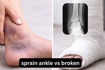 Sprain Ankle vs Broken