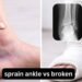 Sprain Ankle vs Broken