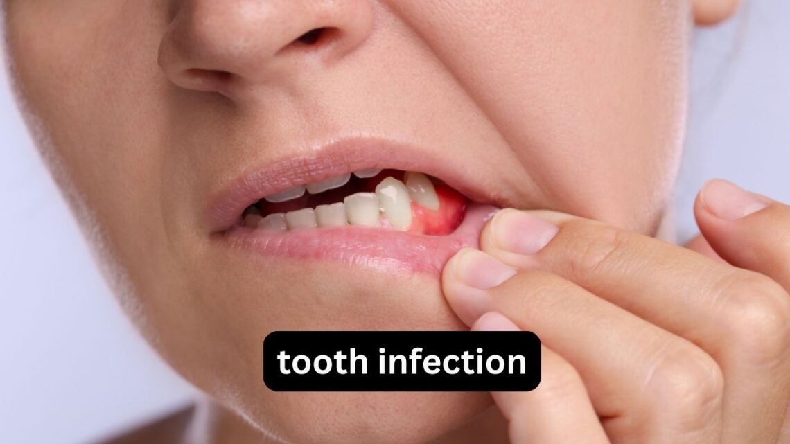 Tooth Infection