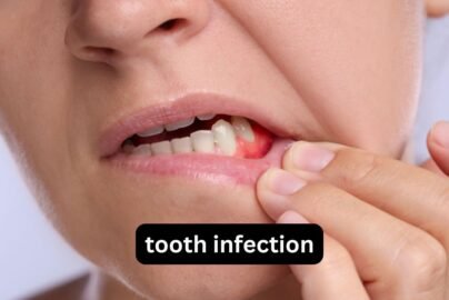 Tooth Infection