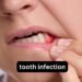 Tooth Infection